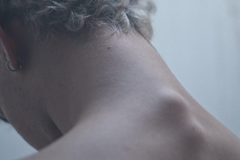 What is Cervical Disc Degeneration?What is Cervical Disc Degeneration?